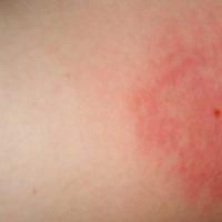 Comment traiter l'enflure et les allergies causées par une piqûre de moucheron